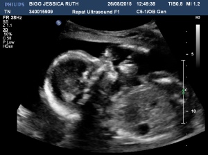 Little Bigg's 12 weeks scan.